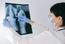 Síndrome de Marfan com escoliose torácica grave associada
