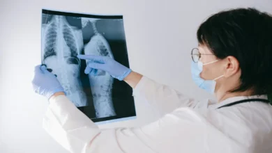 Síndrome de Marfan com escoliose torácica grave associada