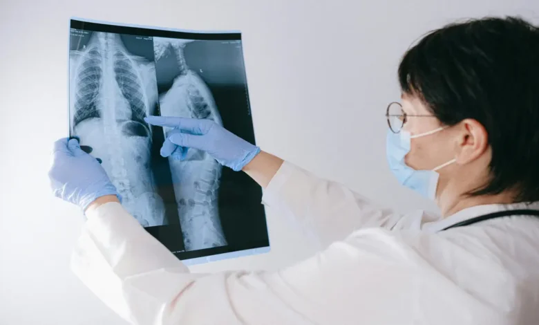 Síndrome de Marfan com escoliose torácica grave associada