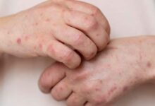 Nova Covid-19? Doença silenciosa avança e vira surto no Brasil